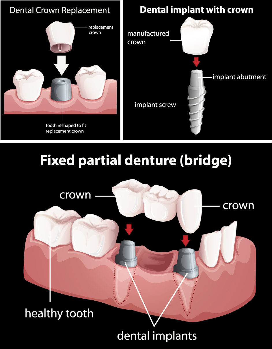 crown