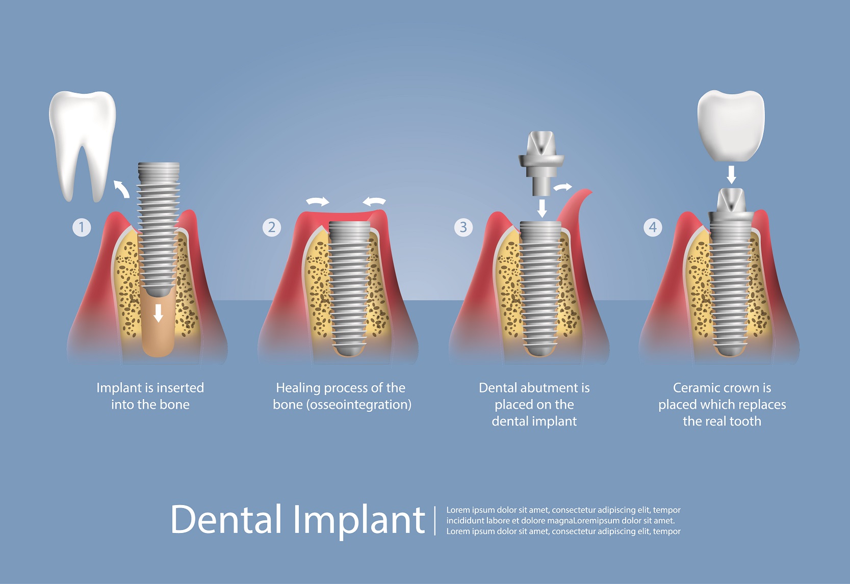 resized-dental_imlpant
