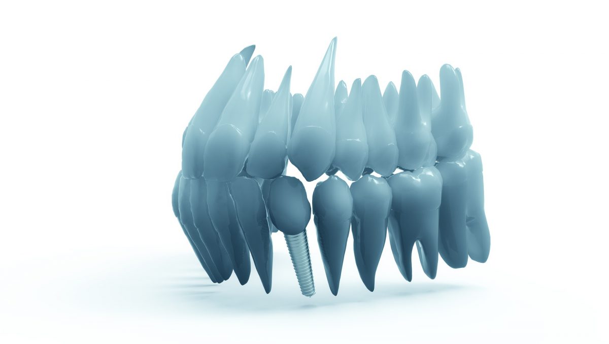 Dental Implants | Bloor Smile Dental
