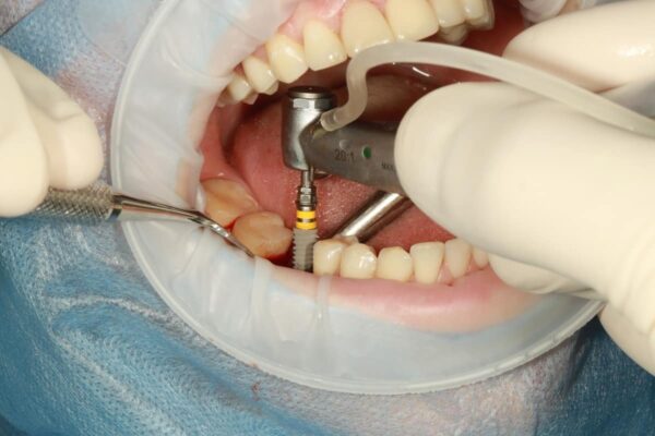 Dental Implants Bloor West Village | Bloor Smile Dental