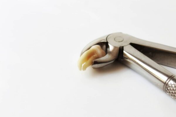 Tooth extraction bloor west village | Bloor Smile dental